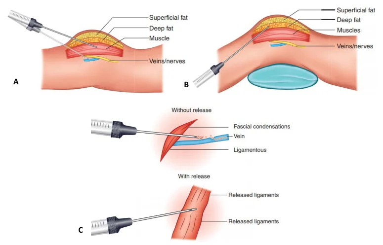 Illustration anatomique ou technique extraite de la thèse