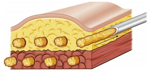Illustration anatomique ou technique extraite de la thèse