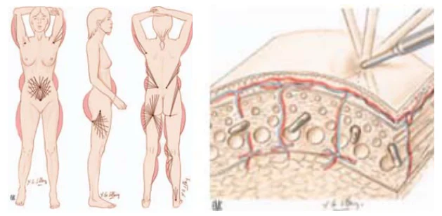 Illustration anatomique ou technique extraite de la thèse