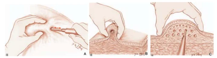 Illustration anatomique ou technique extraite de la thèse